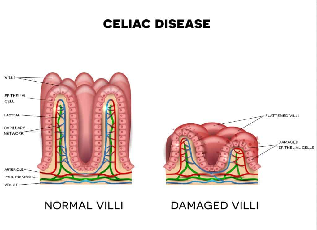Diabetes and Celiac Disease