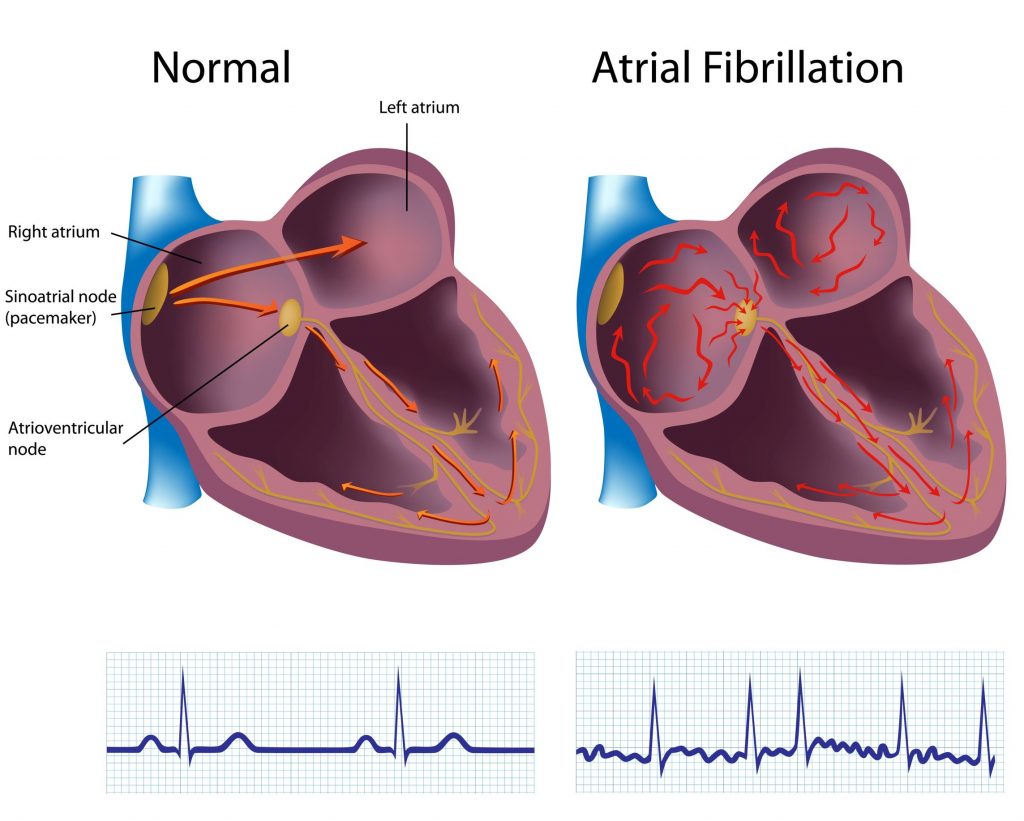 What is Atrial Fibrillation